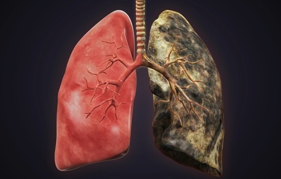 Smokers lungs