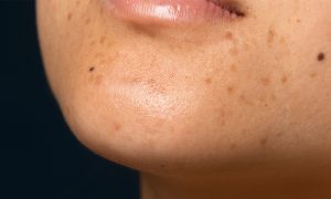 Cara Menghilangkan Flek Hitam Bekas Jerawat