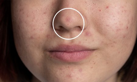 Cara Menghilangkan Jerawat di Hidung