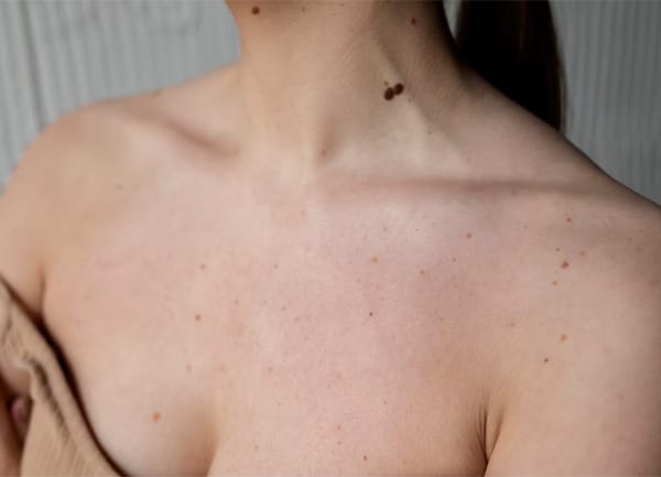 Cara Menghilangkan Bruntusan di Badan