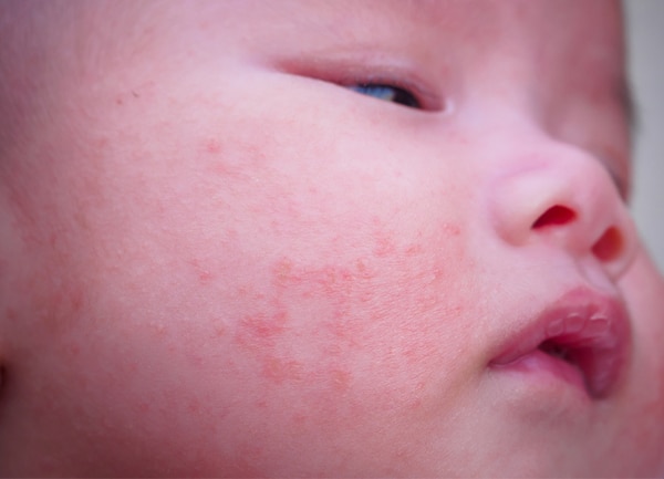 Cara Menghilangkan Bruntusan di Pipi Bayi
