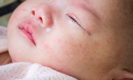 Cara Menghilangkan Bruntusan di Pipi Bayi