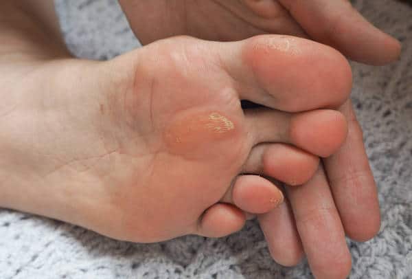 Cara Mengatasi Mata Ikan di Kaki