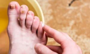 Cara Mengatasi Mata Ikan di Kaki