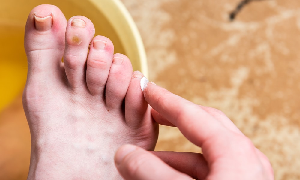 Cara Mengatasi Mata Ikan di Kaki