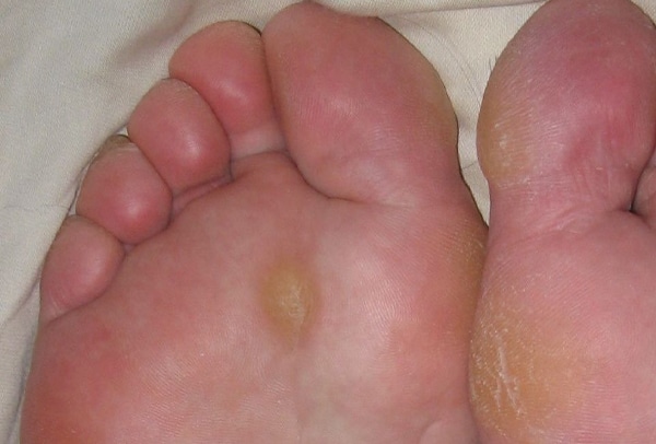 Cara Menghilangkan Kapalan di Kaki