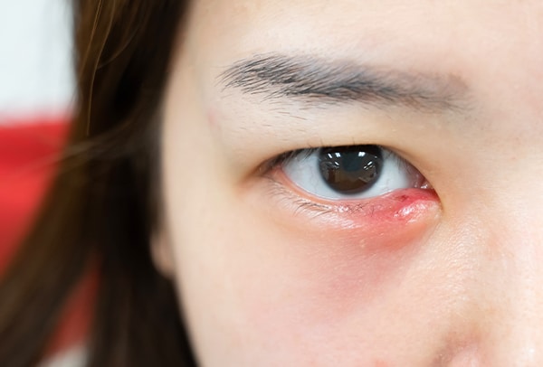 Penyebab dan Cara Mengatasi Mata Bengkak Sebelah