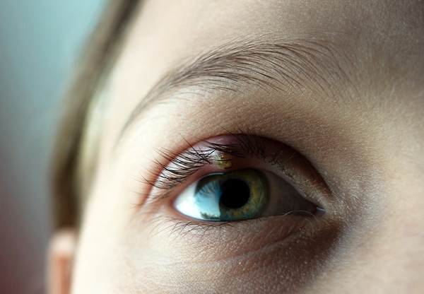 Penyebab dan Cara Mengatasi Mata Gatal
