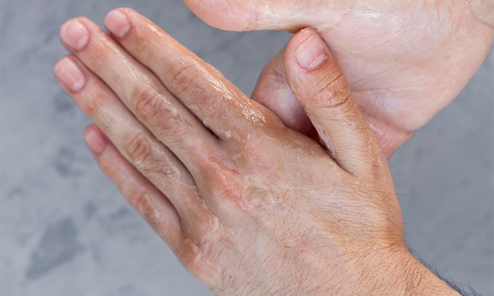 Penyebab dan Cara Mengatasi Tangan Berkeringat Berlebihan
