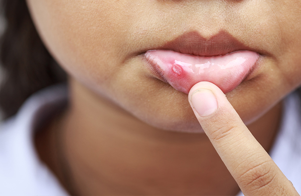 Cara Mengobati Sariawan di Bibir dengan Cepat