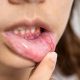 Cara Mengobati Sariawan di Bibir dengan Cepat